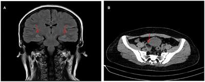 Case Report: Anti-NMDA Receptor Encephalitis With Bilateral Hearing Loss as the Initial Symptom